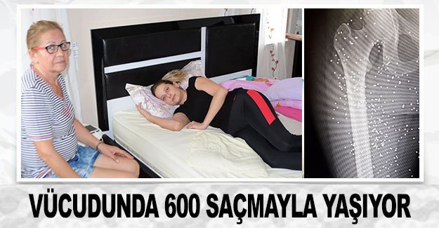 Vücudunda 600 saçmayla yaşıyor