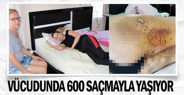 Vücudunda 600 saçmayla yaşıyor